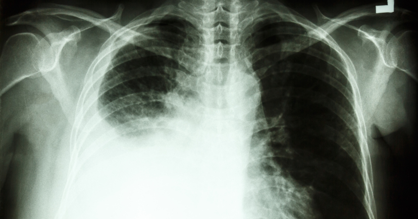 肺のレントゲン写真